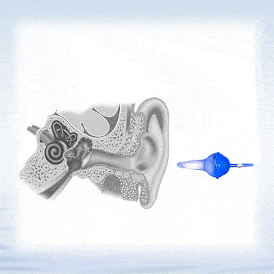 CZTICLE®💥2025 NEW DESIGN-👂The World's First Fluid Inflatable Earplug